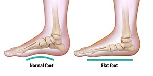 Flatfoot Treatment Greater Manchester | Foot Deformity Treatments ...